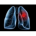 Cancer Pulmonar